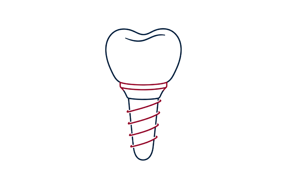 Implantes dentários