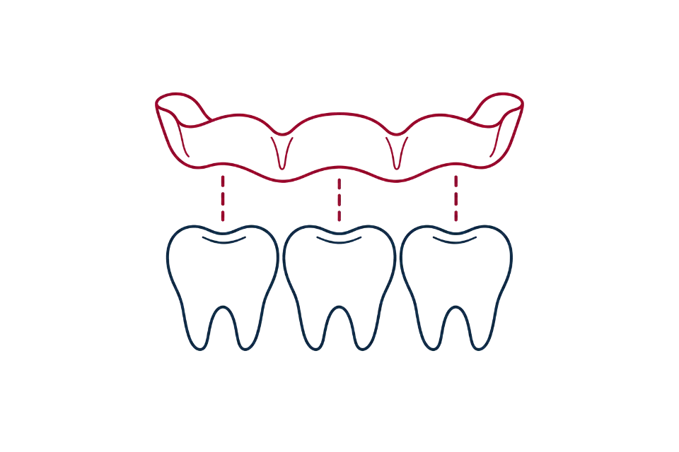 Invisalign